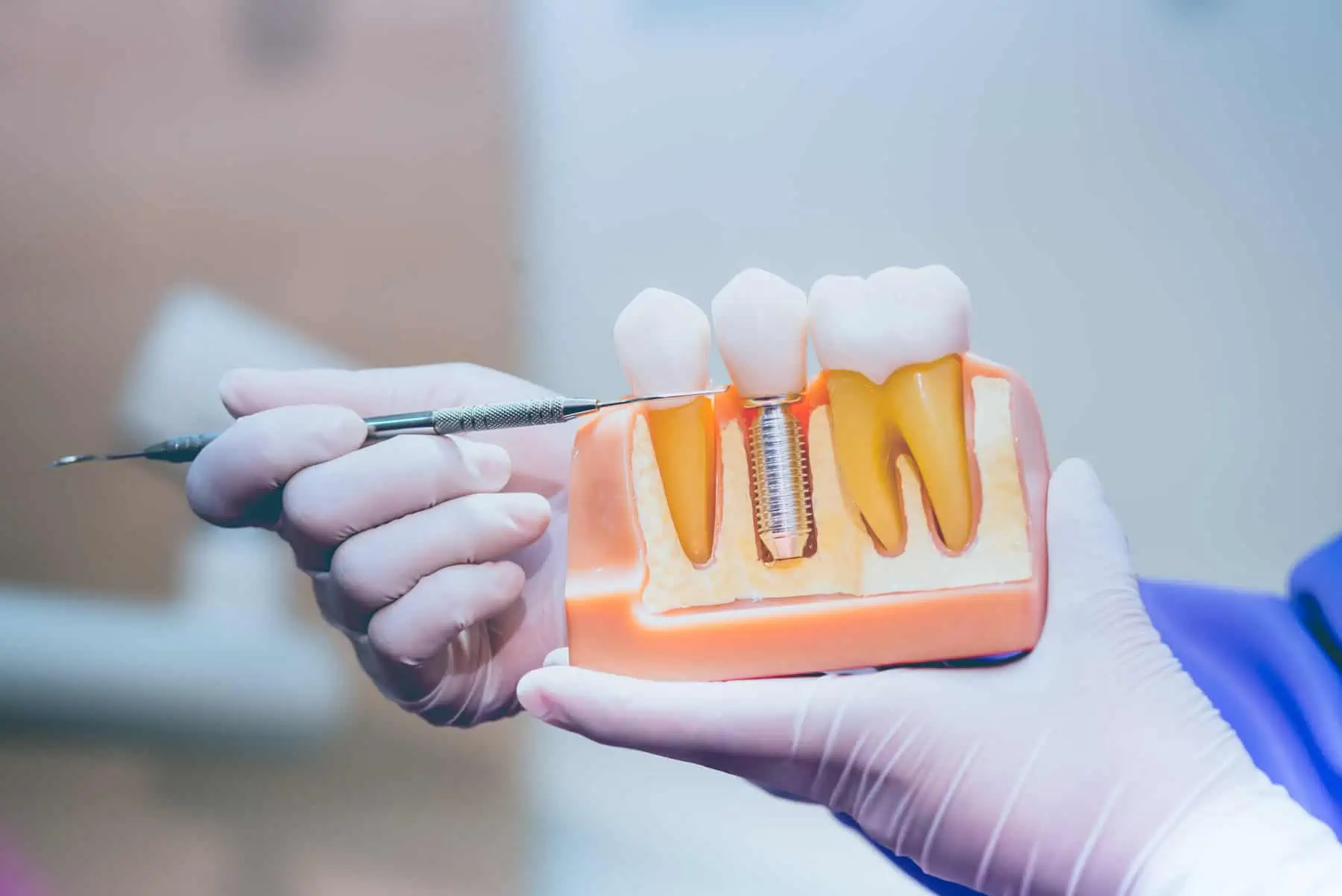 Dental implant illustration showing titanium post and crown