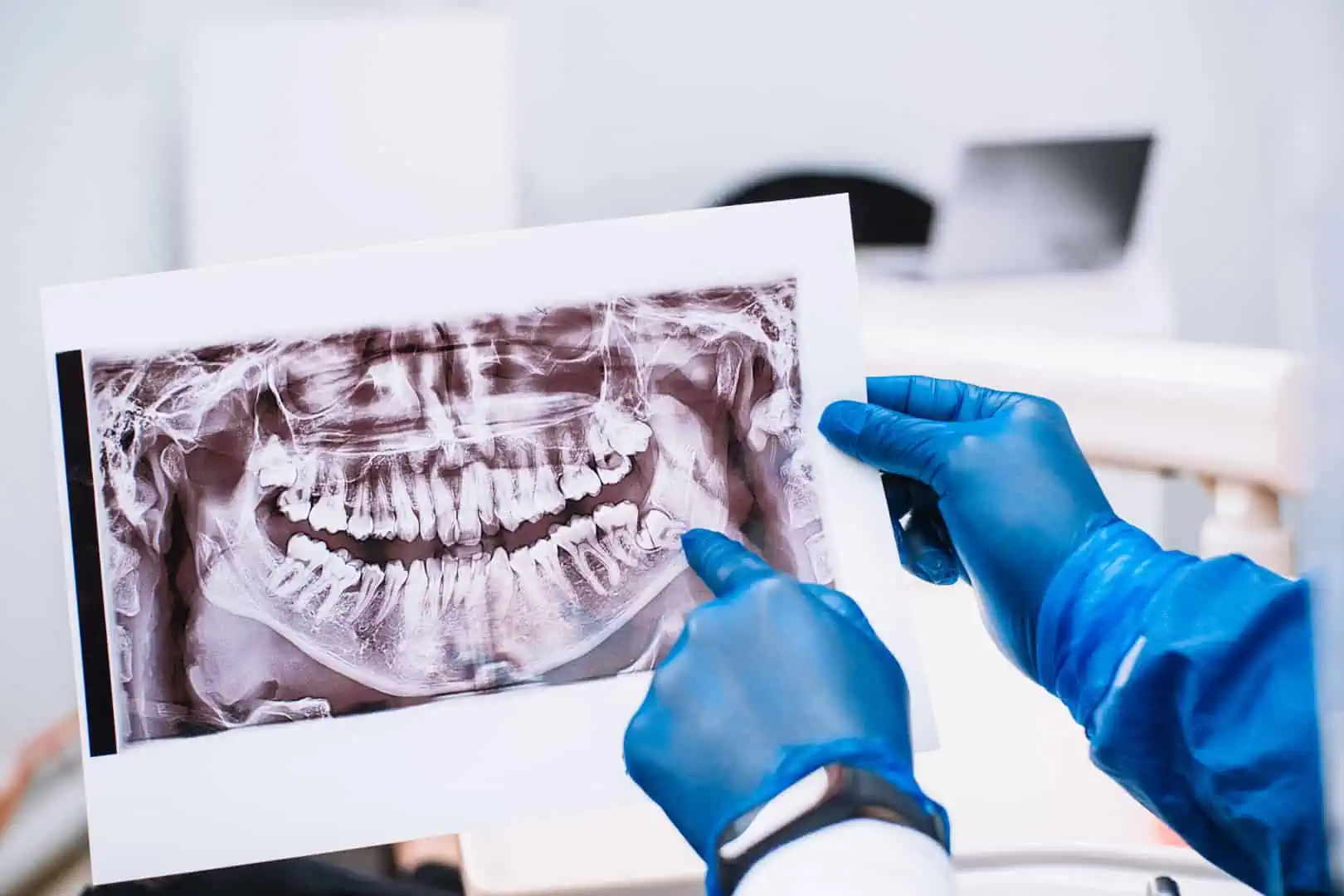 Wisdom teeth surgical extraction procedure